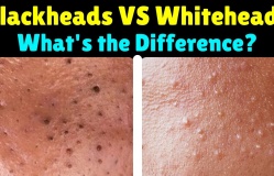 Blackheads vs. Pimples: What’s the Difference?