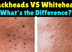 Blackheads vs. Pimples: What’s the Difference?