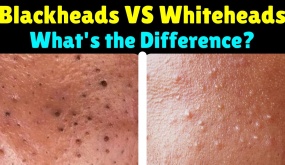 Blackheads vs. Pimples: What’s the Difference?